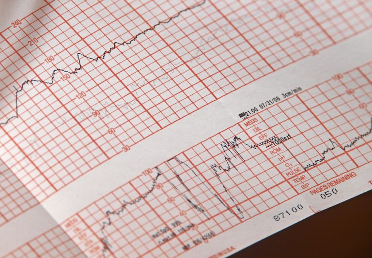 Víte, jak se měří zátěžové EKG?
